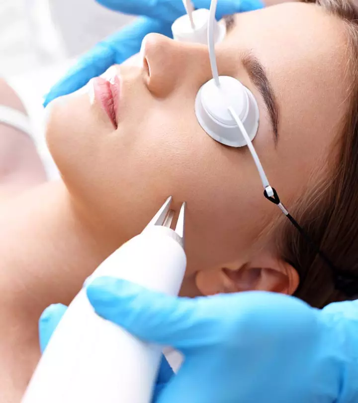 Fractional CO2 laser illustration