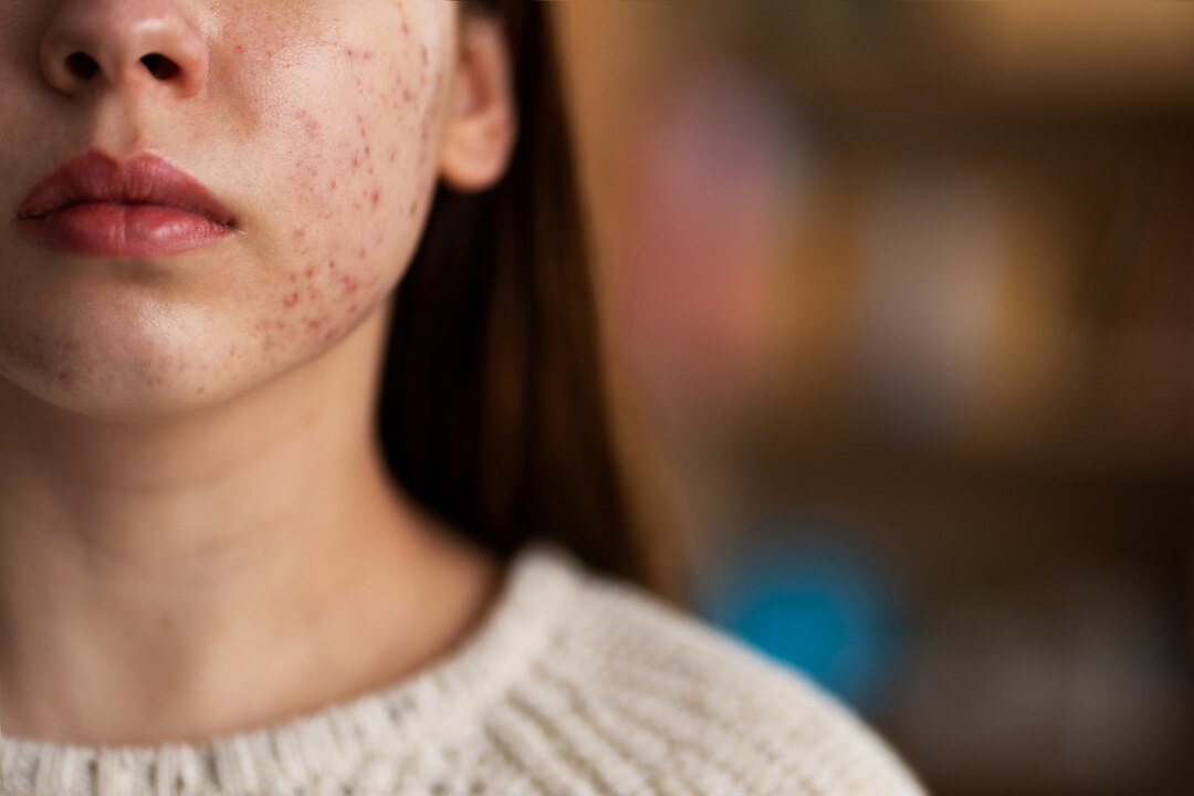 Acne treatment illustration