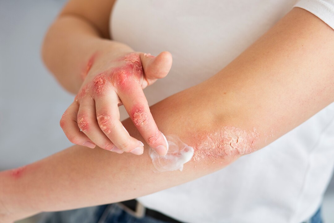Psoriasis management illustration